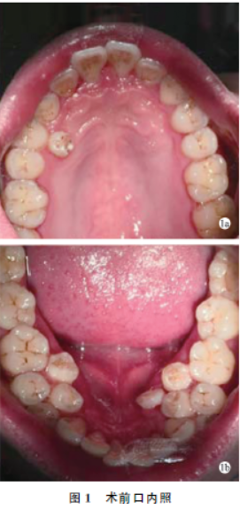 成人上下颌双侧前磨牙区7颗多生牙病例分析