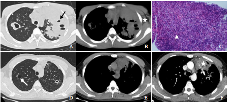浅析以空洞或囊腔为主的肺内淋巴瘤的ct表现